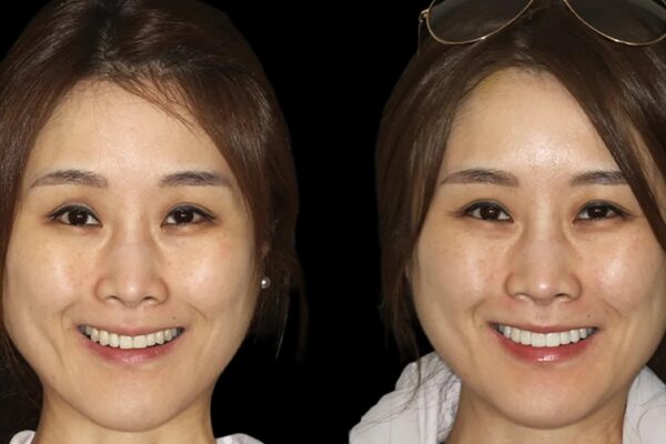 Veneers -index 1