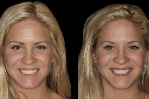 Veneers -index 11
