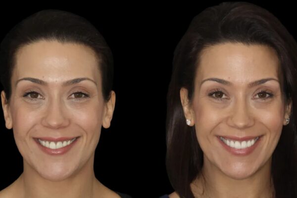 Veneers -index 14
