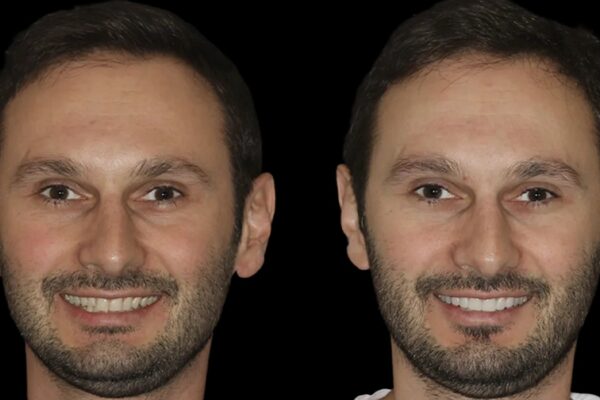 Veneers -index 2