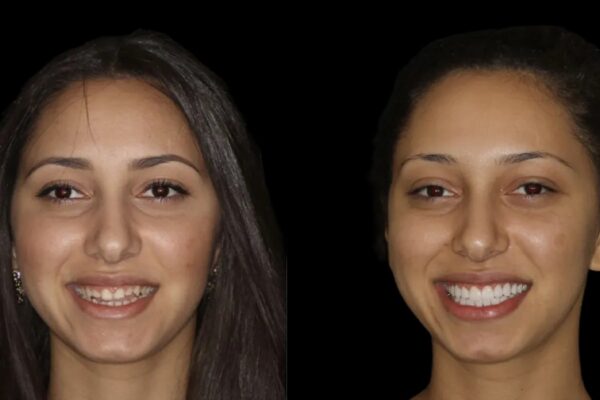 Veneers -index 6