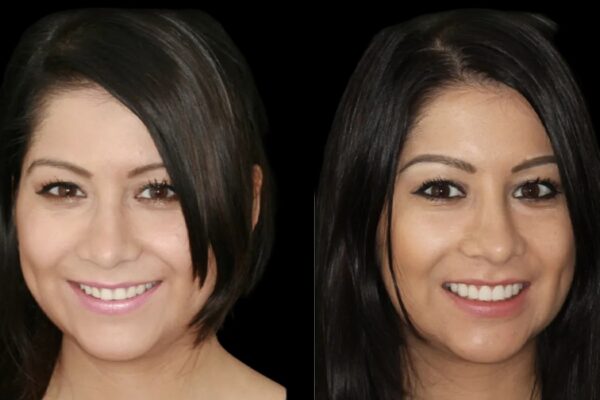 Veneers -index 9