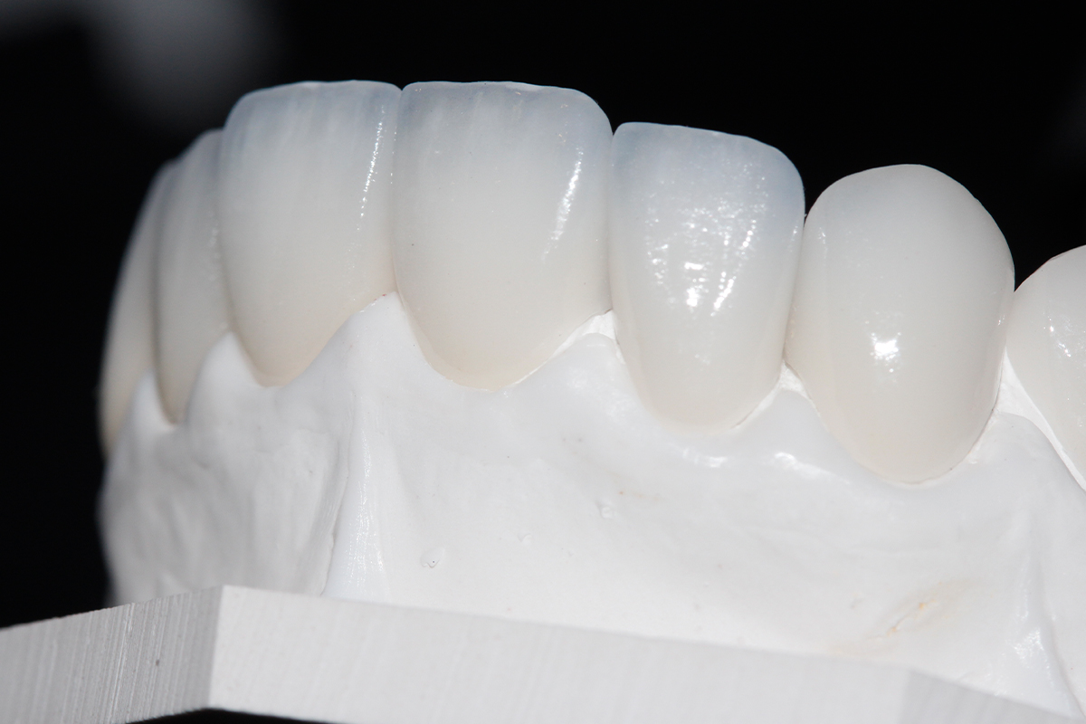Close-up of a set of porcelain veneers from BioDental in Encino.